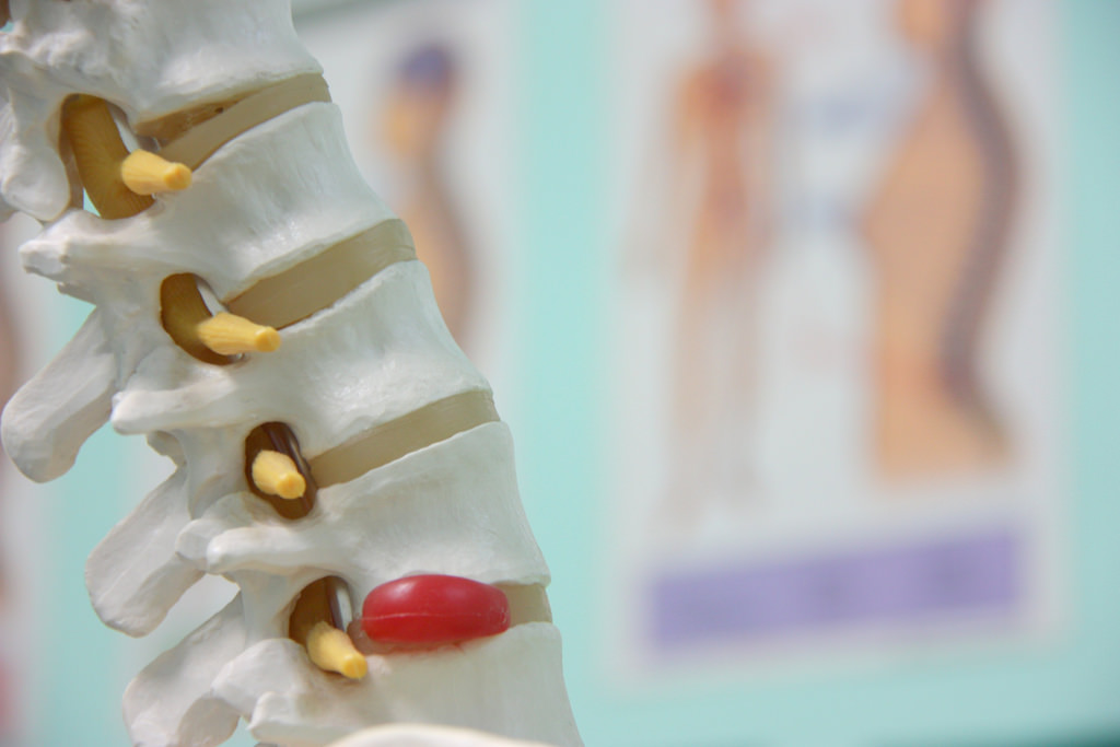 Can Herniated Disc Pain Be Treated Without Surgery? HeadtoToe Blog